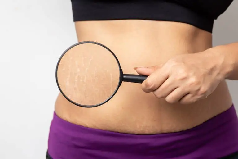 Everything About Stretch Marks During Pregnancy